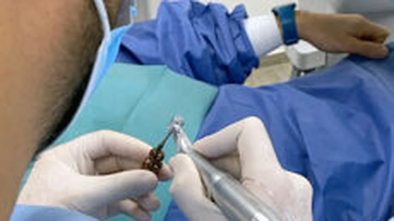 ICX-ACTIVE LIQUID: Single tooth implantation with open sinus lift. UPDATE – Prosthetics!